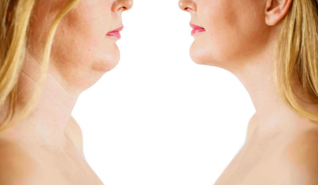 Double Chin treatment Herefordshire before and after results