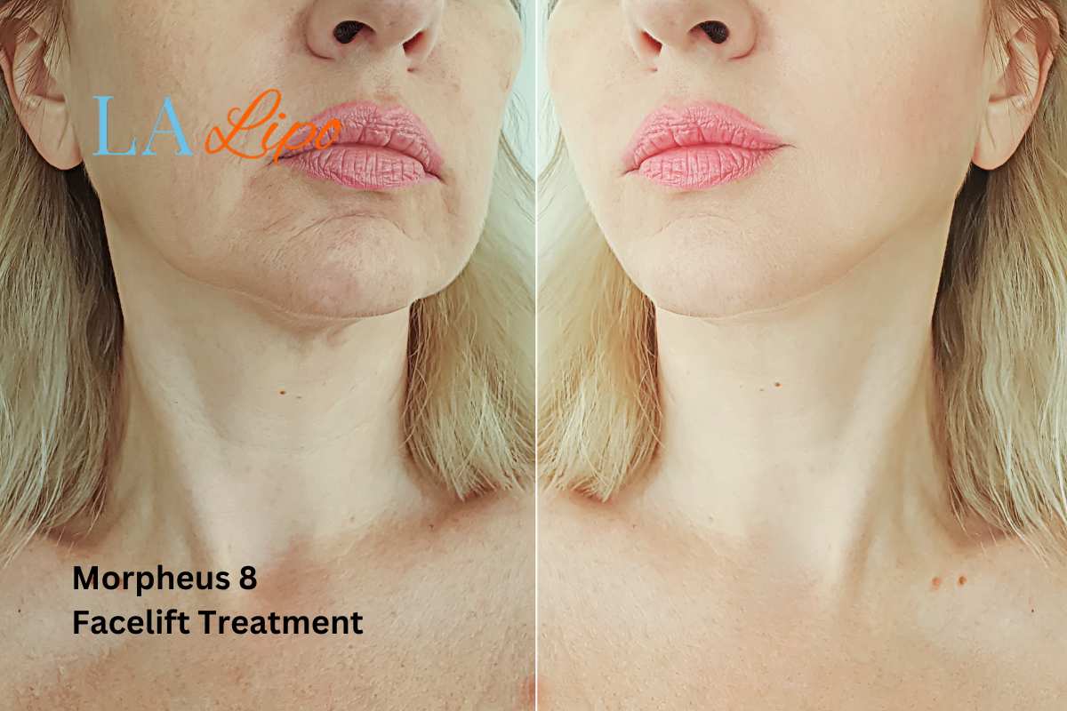 Turn back time with Morpheus8 Treatment Herefordshire