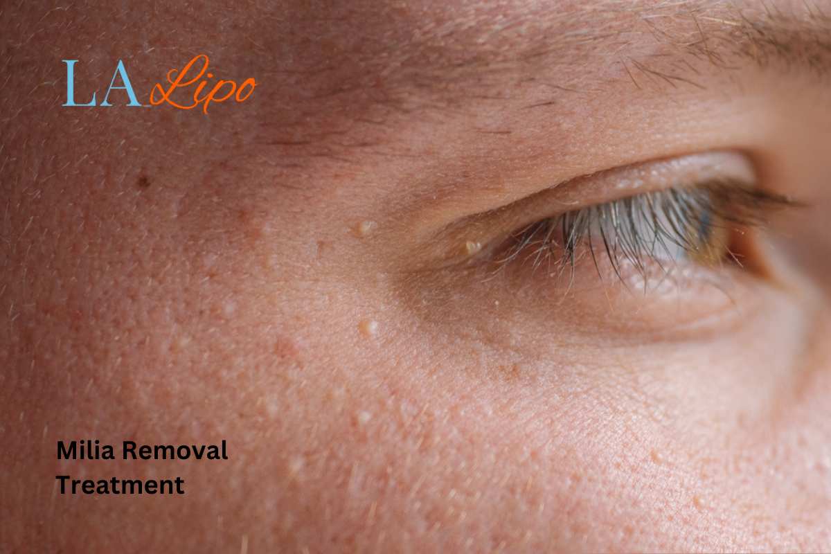 Cryopen Milia Removal: Is It the Easiest and Safest Option Herefordshire?