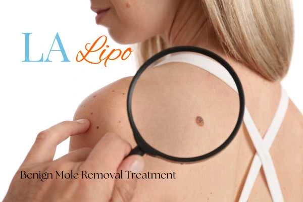 Woman having her inspection of blemish before mole removal Herefordshire