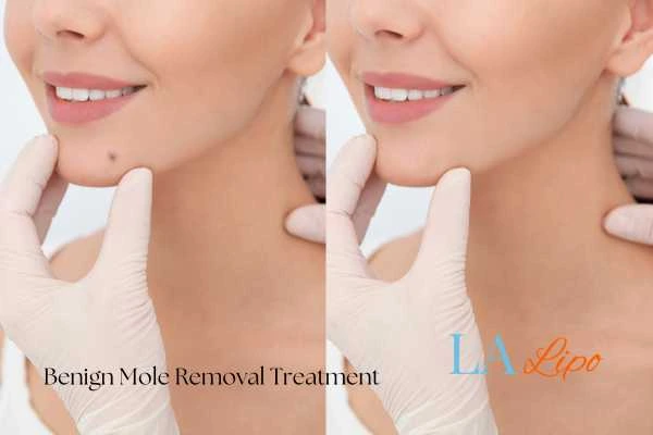 Before and after mole removal Herefordshire treatment
