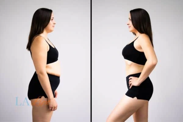 image of woman before and after results of LA-EMS Body Sculpting Herefordshire to help treat Diastasis recti