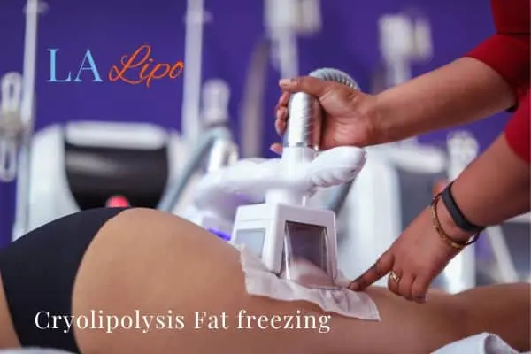 women getting fat freezing Herefordshire