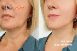 hi-fu for wrinkles Herefordshire before and after results