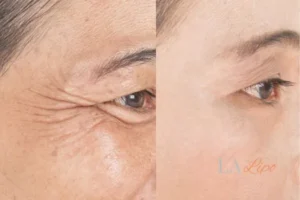 Before and after results of woman - HI-fu wrinkles reduction treatment Herefordshire