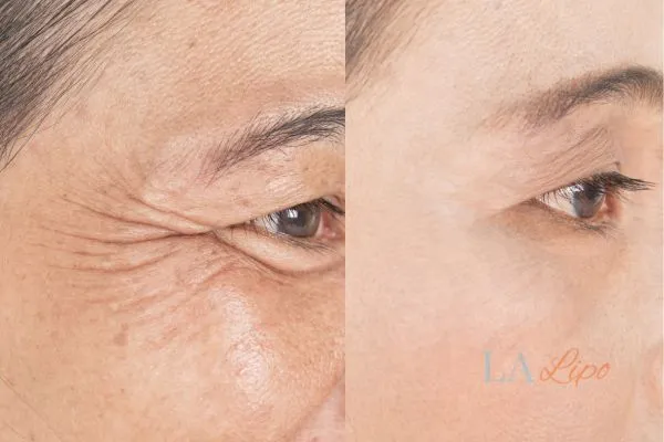 Before and after results of woman - HI-fu wrinkles reduction treatment Herefordshire