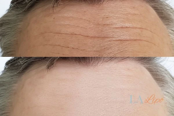 results of HIFU Herefordshire on mans forehead to help reduce lines and wrinkles