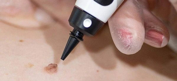 skin tag removal using cryopen Herefordshire
