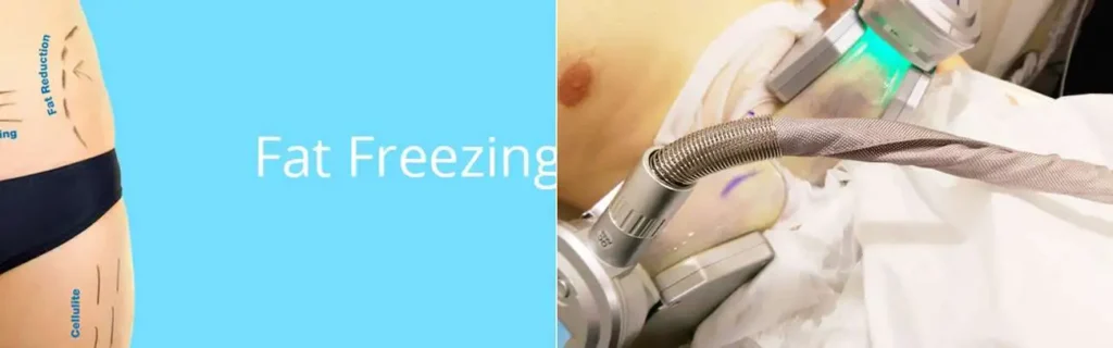 Fat freezing Herefordshire on multiple areas of the body