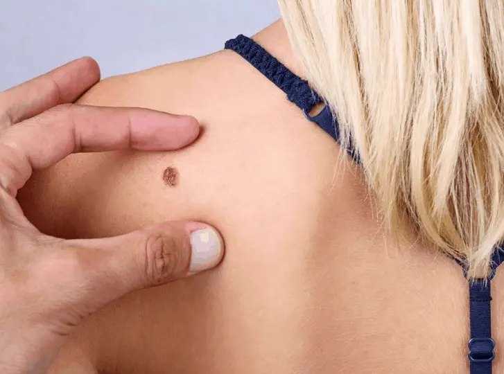 woman having mole removal Herefordshire consultation before treatment.
