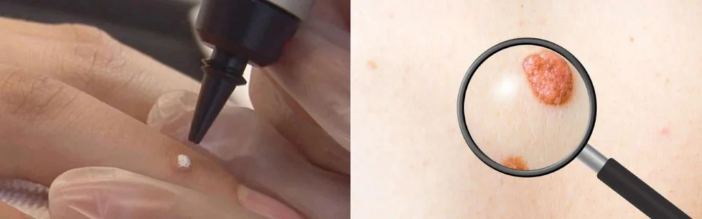 Person getting moles removed with cryopen Herefordshire