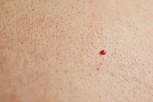 close up of a cherry angioma Herefordshire