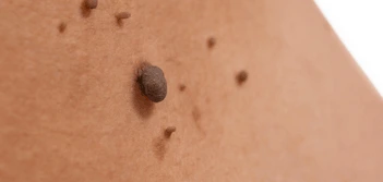 image of a skin tag Herefordshire