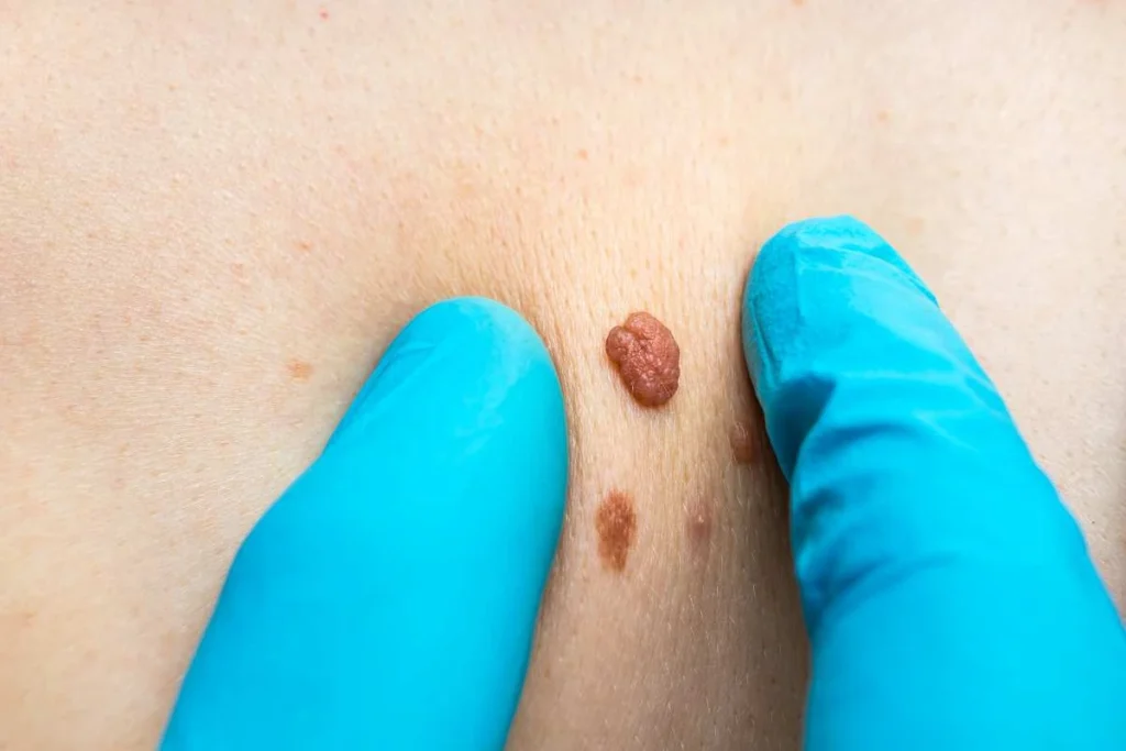 Consultant examining a skin tag Herefordshire
