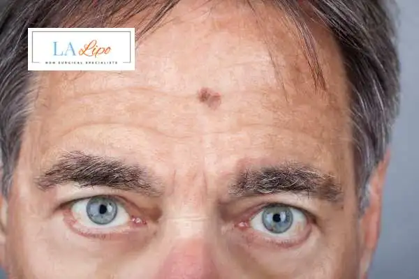 Solar Lentigo Removal Herefordshire image of man with mark on his forehead