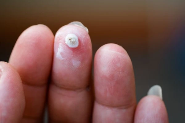 wart on person finger - cryotherapy to treat from LA LIPO Herefordshire