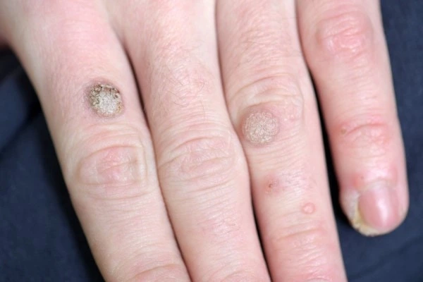 photo of warts on person hand - see wart removal Herefordshire from LA LIPO