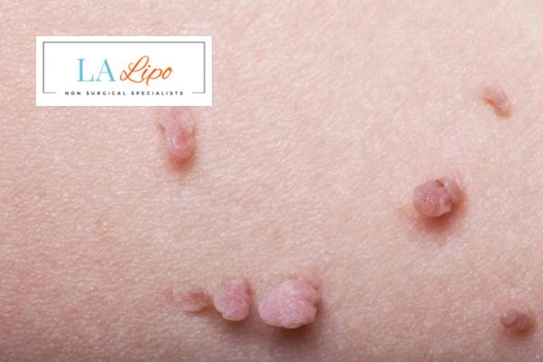 Does cryopen skin tag removal Herefordshire hurt? Find out now call our team today!