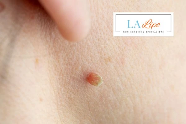 Book skin tag removal Herefordshire today speak to our team now!