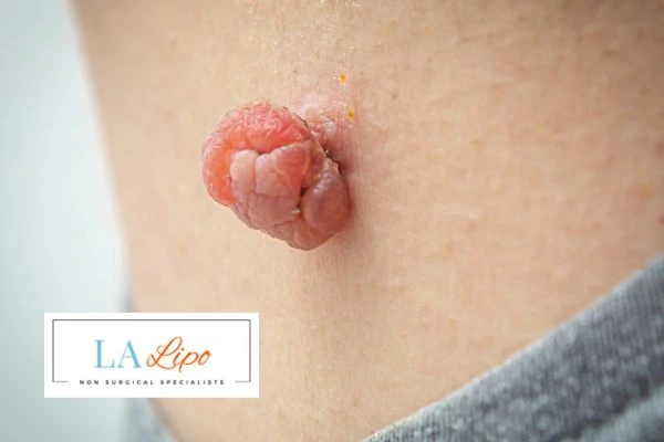 Interested in skin tag removal Herefordshire? Concerned about the pain? Find out more today!