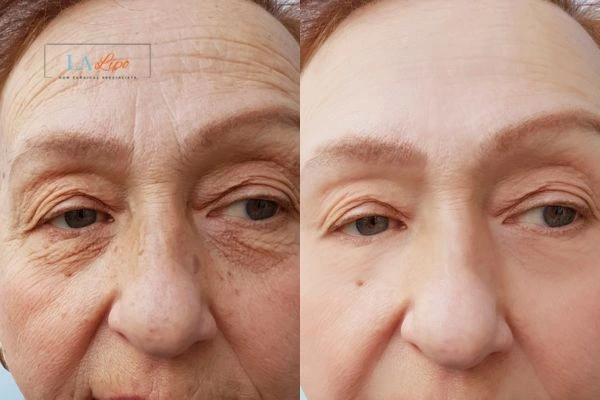 The powerful benefits of Morpheus8 Treatment Herefordshire - Call Our team today!