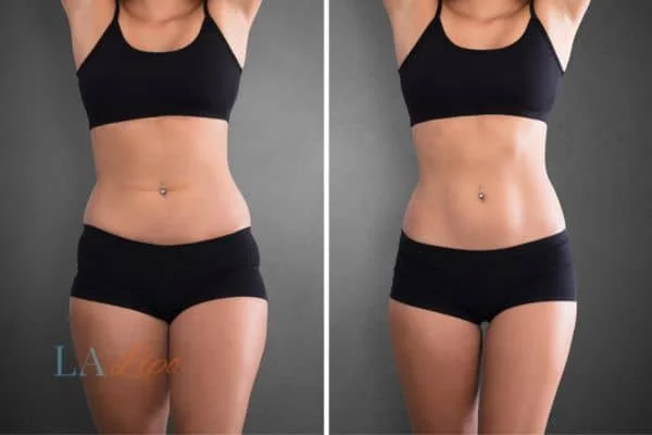 before and after results of non-surgical treatment to help a woman's body image and mental health Herefordshire