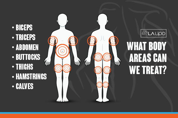Diagram to show areas you can have LA-EMS Body Sculpting Treatment Herefordshire