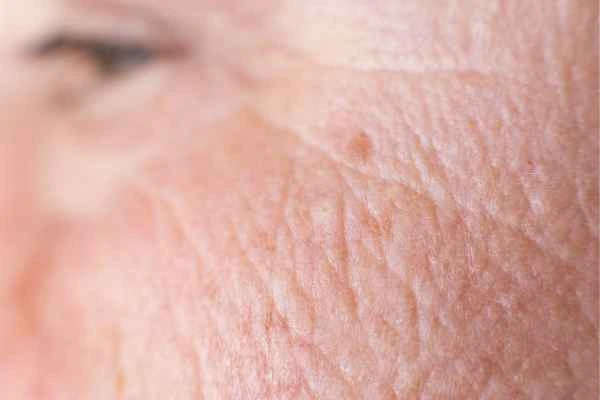 close up picture of a woman's face showing an age spot Herefordshire
