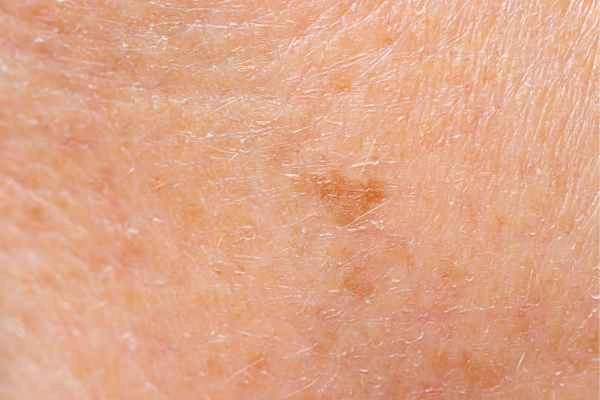 close up picture of age spots Herefordshire