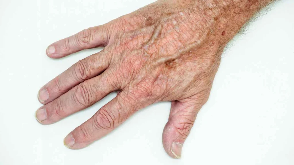 Male hand showing age spot Herefordshire
