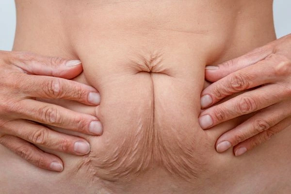 Image of a woman's stomach with loose skin - example of skin tightening Herefordshire options