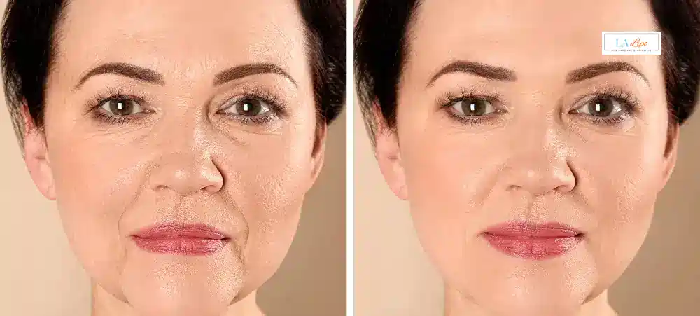 How Long Does It Take to See Results and How Long Do They Last Herefordshire?