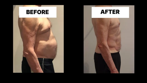 What Symptoms Can Diastasis Recti Cause in Men? Weak Core, Back Pain and Poor Posture Herefordshire